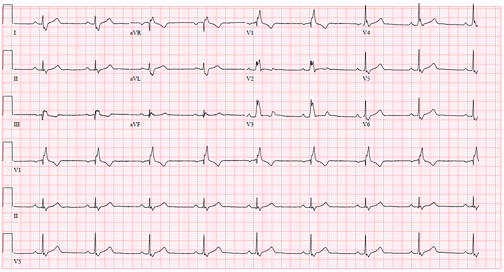 12-lead-EKG:-normal-sinus-rhythm,-with-right-bundle-branch-block