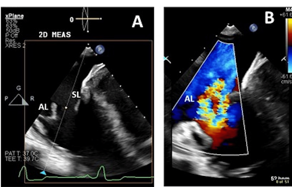 Still-frame-images-of-transesophageal-echocardiogram-of-the-tricuspid-valve-regurgitation.-A.-Four-chamber-view-showing-the-flail-of-anterior-leaflets-of-tricuspid-valve;-B.-Color-comparison-images-demonstrating-the-severe-tricuspid-regurgitation-through-the-coaptation-gap
