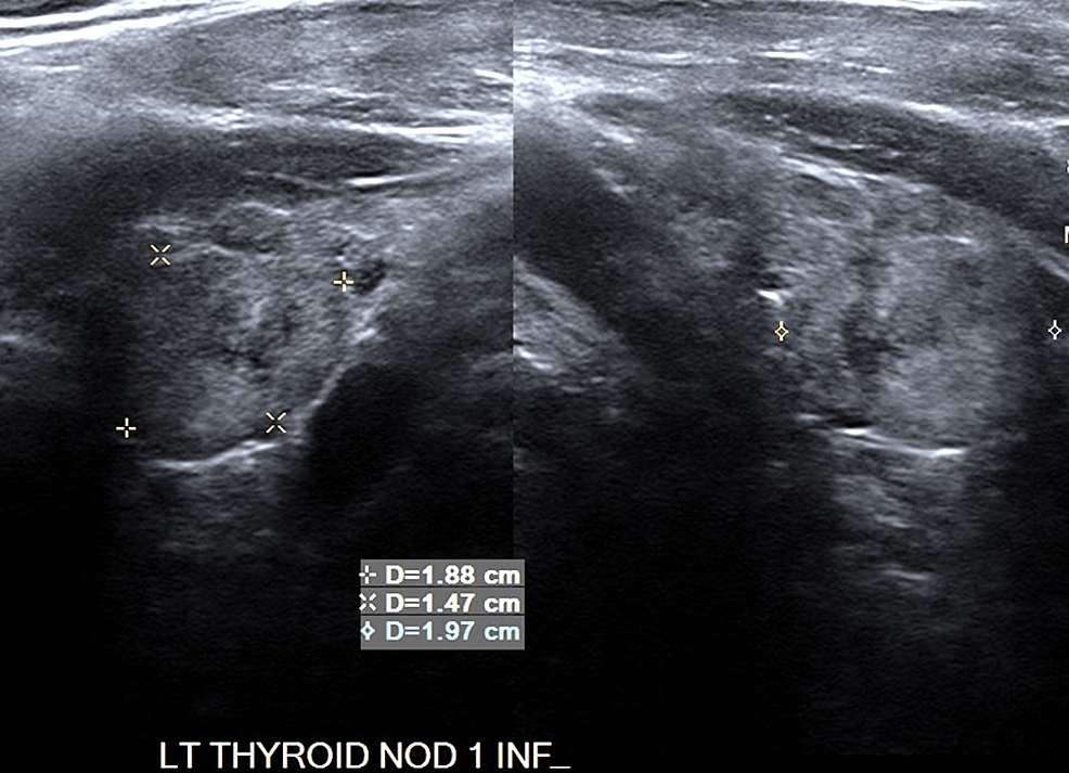 Multinodular-Left-(Inferior)-Thyroid-Ultrasound