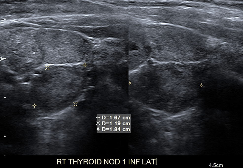 Multinodular-Derecho-(Inferolateral)-Tiroides-Ultrasonido