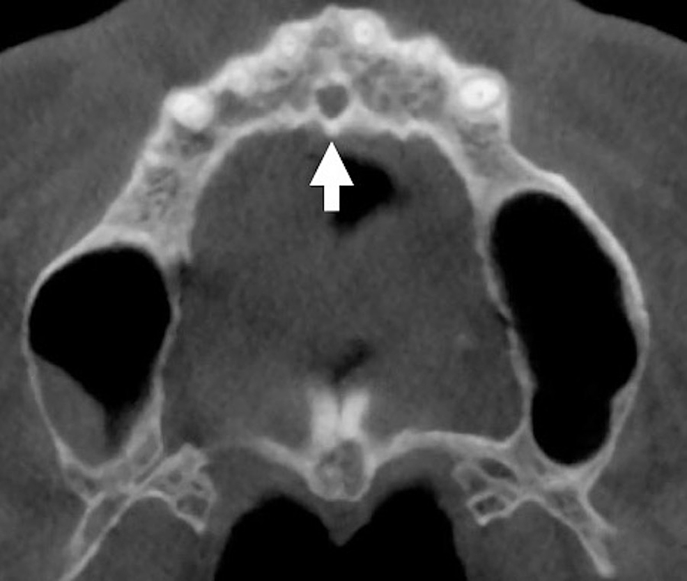 measurement-of-nasopalatine-canal-length-a-incisive-foramen-diameter