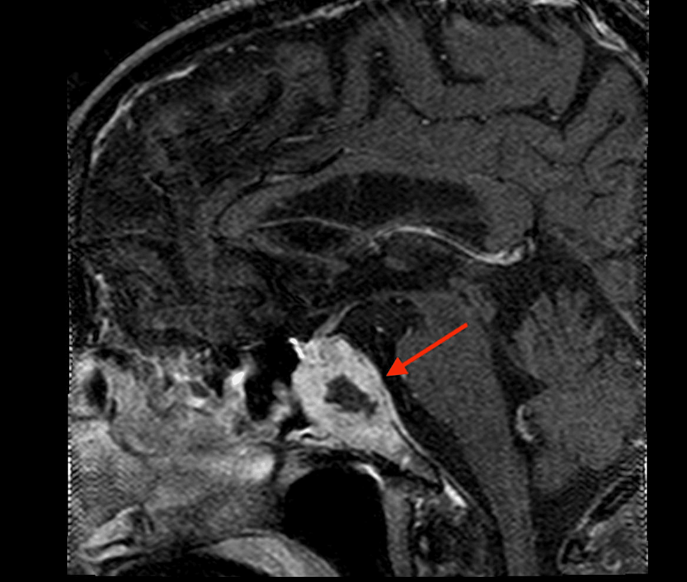 Sagittal-MRI-of-the-metastatic-lesion-abutting-the-optic-chiasm-(arrow).