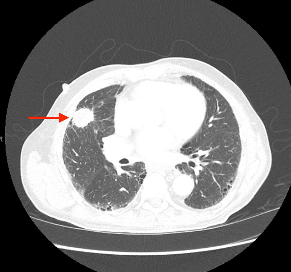 Axial-chest-CT-demonstrating-the-presence-of-a-right-upper-lobe-spiculated-mass-(arrow).