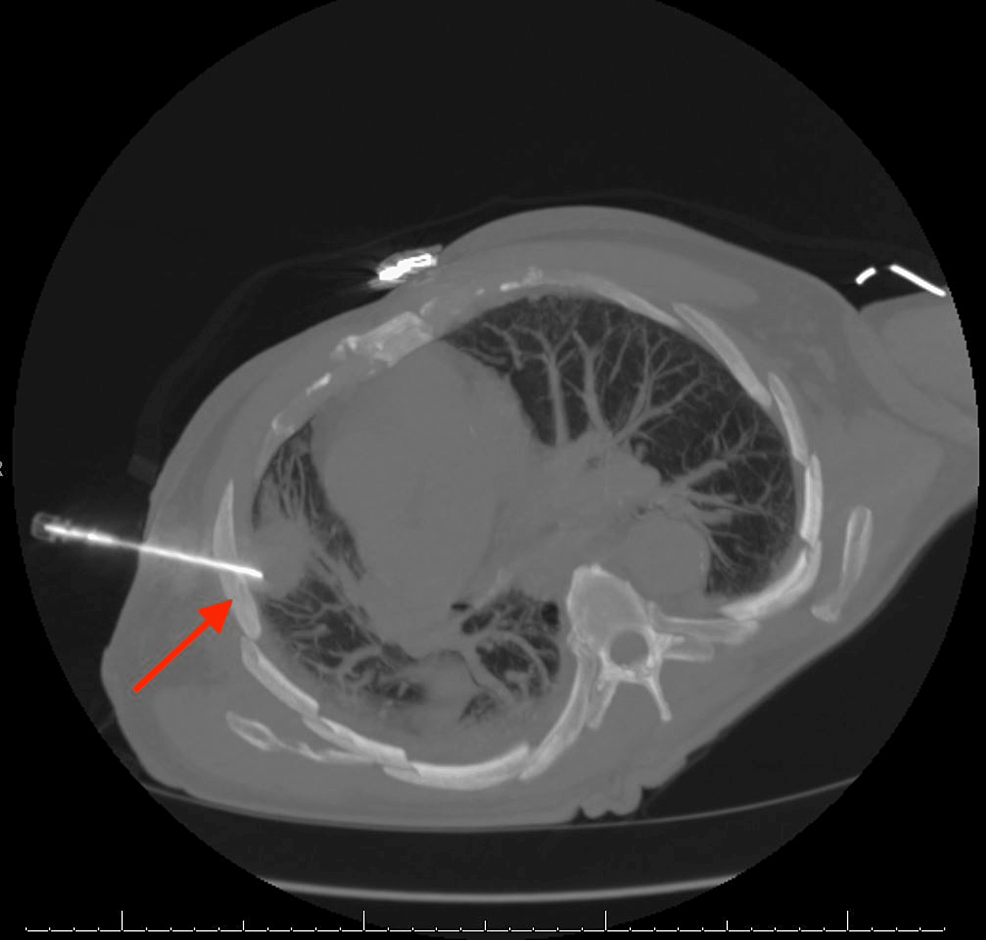 Core-needle-biopsy-(CT-guided)-of-the-right-lung-mass-(arrow).