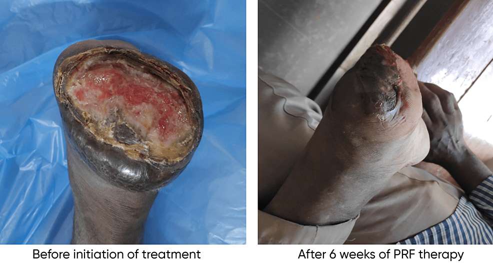 Patient-1-with-postoperative-(forefoot-amputation)-nonhealing-ulcer-over-the-stump-before-and-after-treatment-with-PRF
