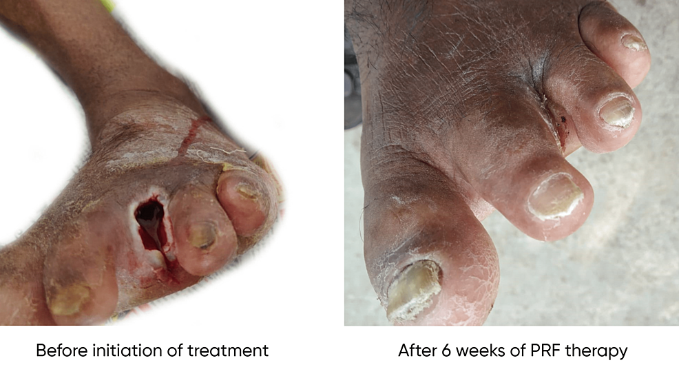 Patient-2-with-nonhealing-ulcer-after-ray-amputation-of-the-third-toe-before-and-after-treatment-with-PRF