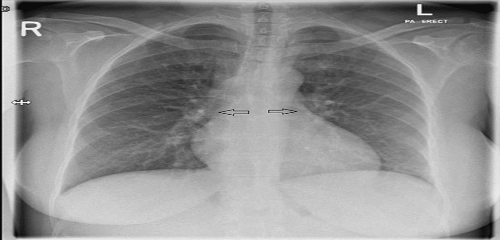 Severe Myocarditis in a Female Following mRNA-1273 Vaccine: A Case ...