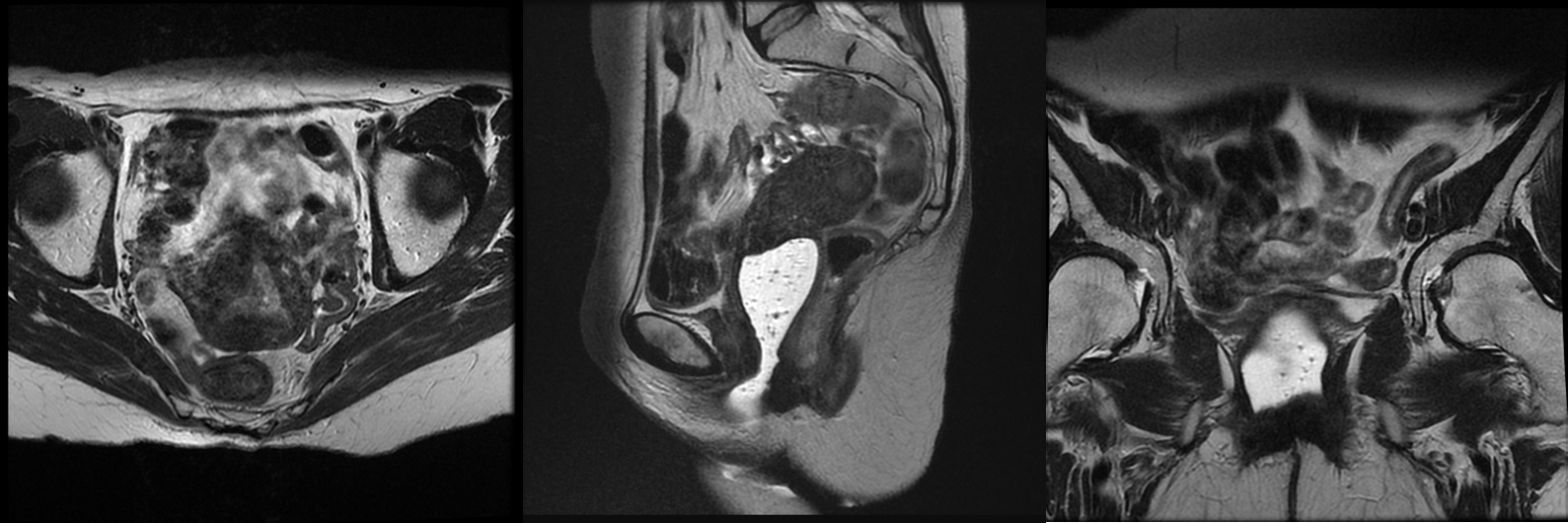 Complete Pathologic Response Following Neoadjuvant Chemoradiotherapy ...