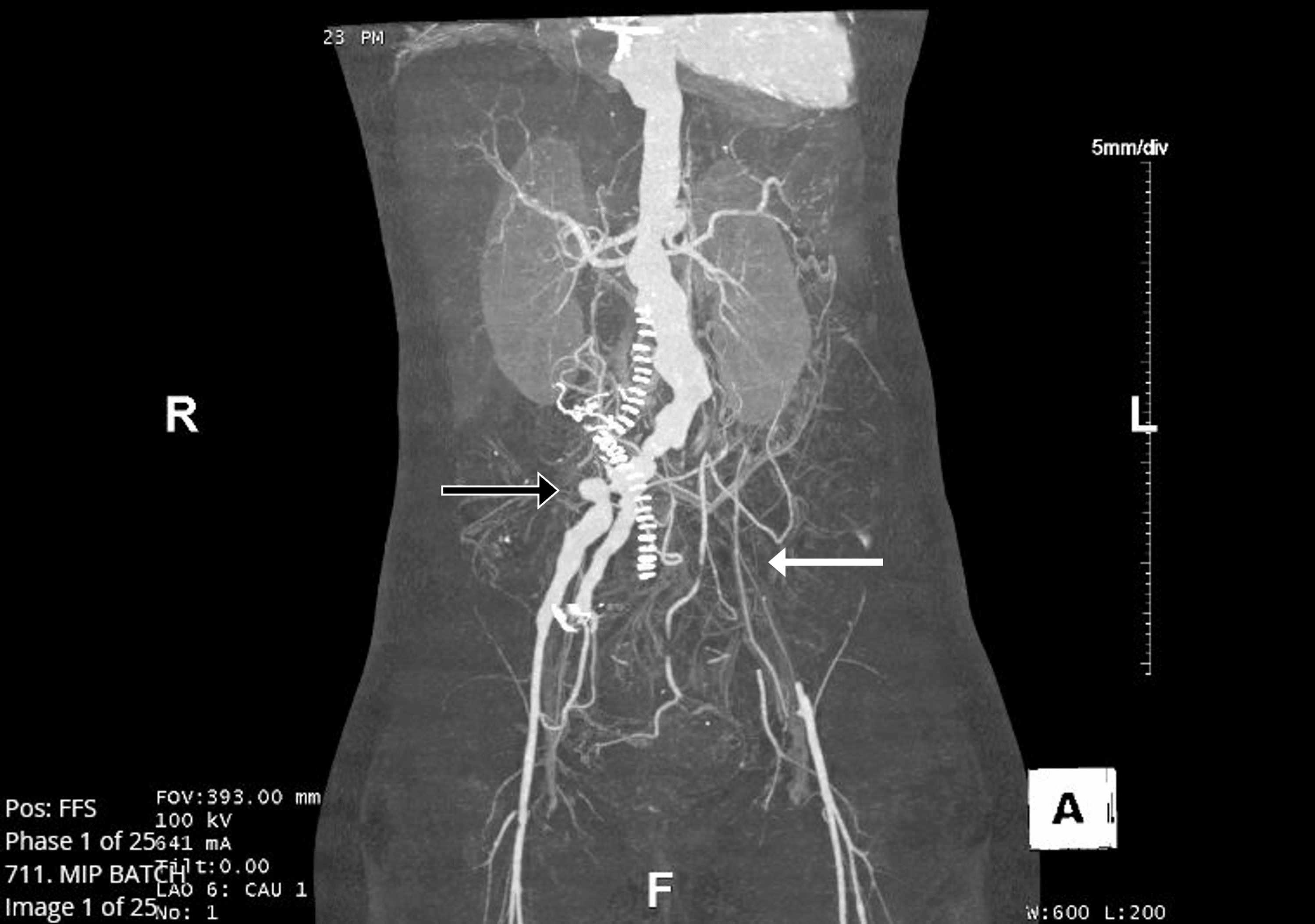 Cureus Takayasus Arteritis With Acute Severe Aortic Regurgitation