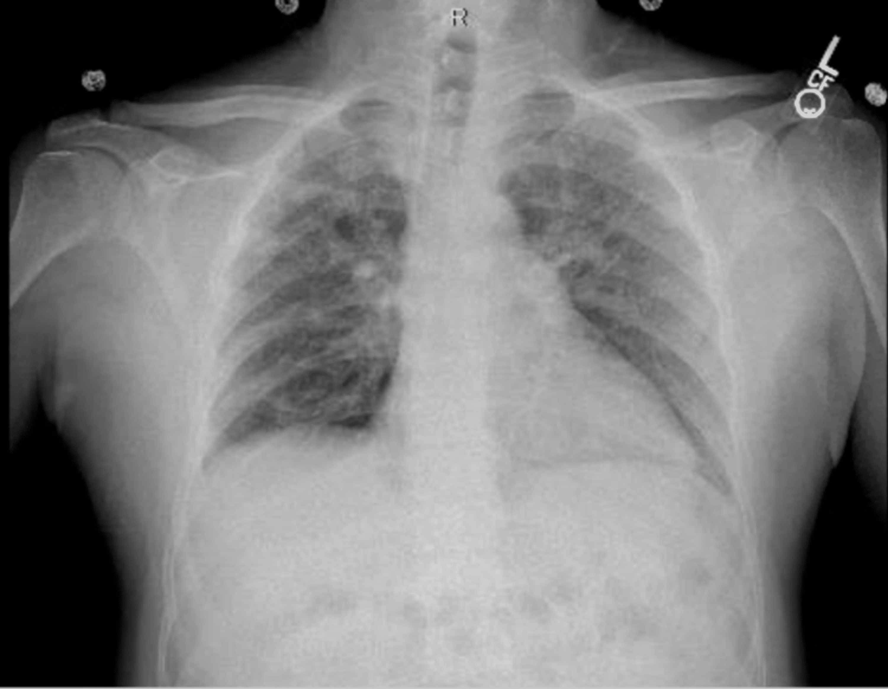 Cureus | An Interesting Case of Mixed Dust Pneumoconiosis With