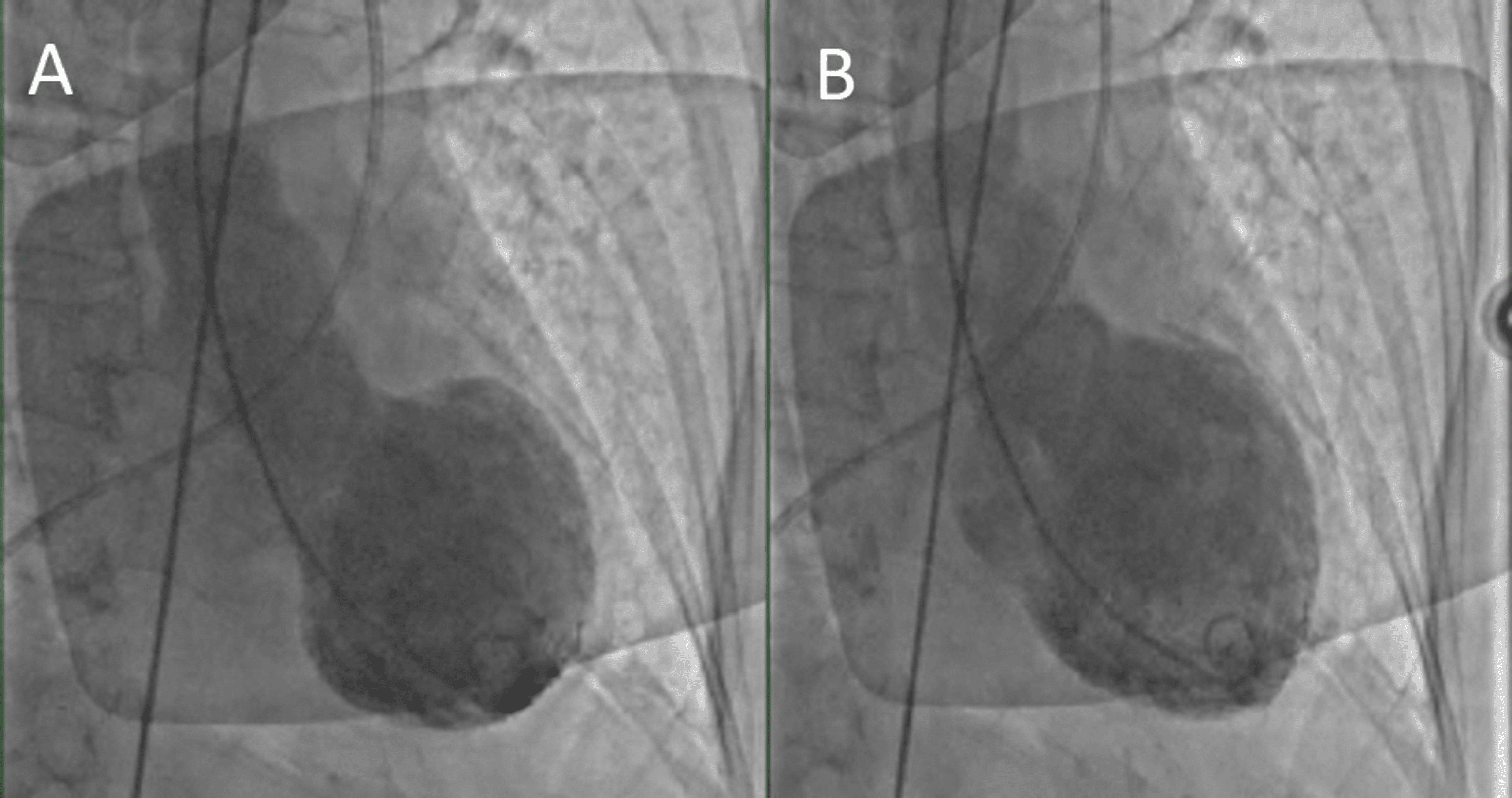 Cureus | Management Challenge: An Atypical Variant of Takotsubo ...