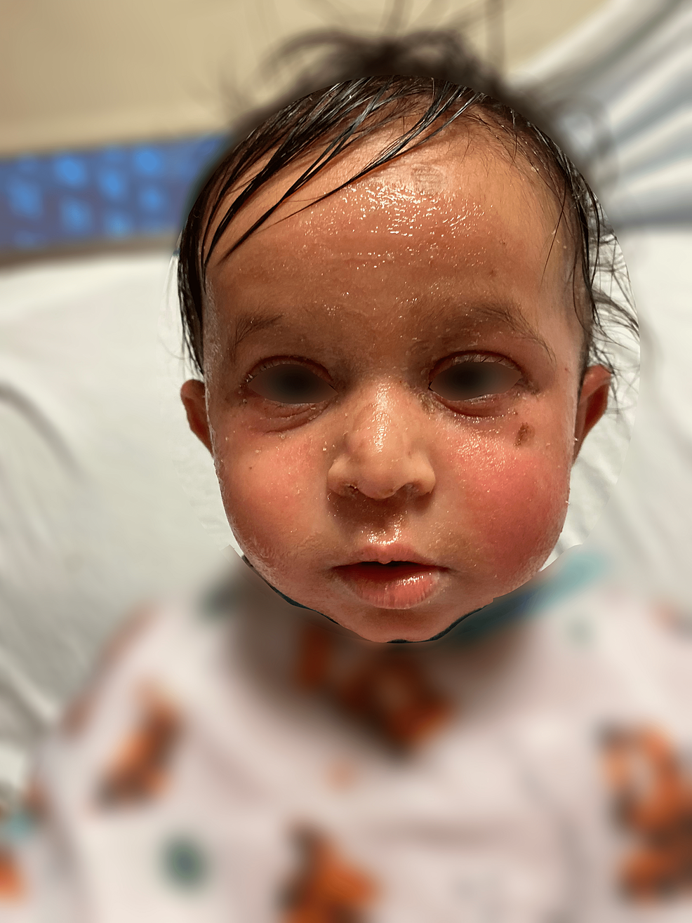 Cureus Staphylococcal Scalded Skin Syndrome In A Ten Month Old Male