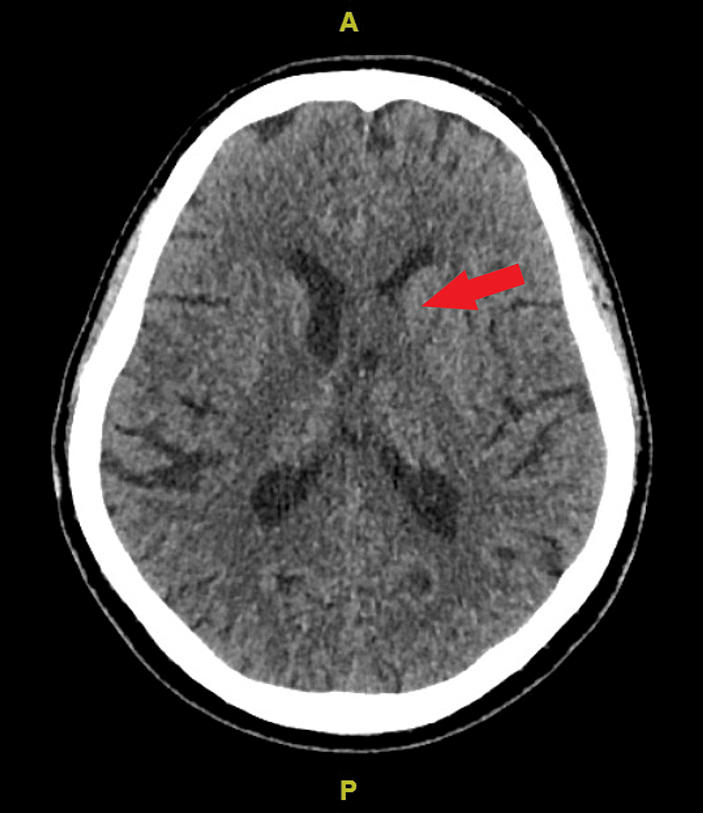 Axial-cut-of-the-plain-computed-tomography-image-showed-a-mass-compressed-on-the-left-lateral-ventricle-(red-arrow).