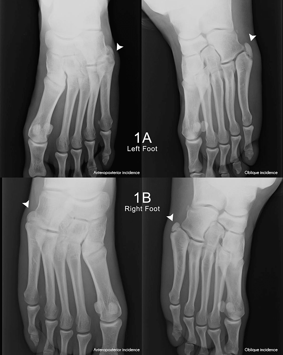 Left-(1A)-and-right-(1B)-foot-anteroposterior-and-oblique-radiographs