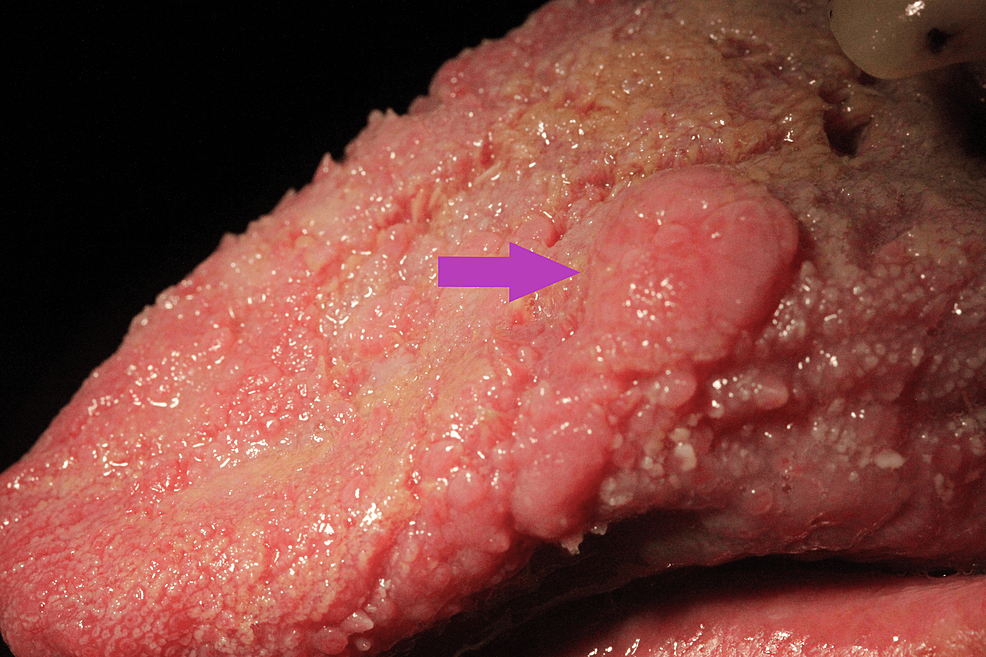 Lesion-A---Peduncle-solid-mass on-dorsum-of-the-tongue (purple-arrow)