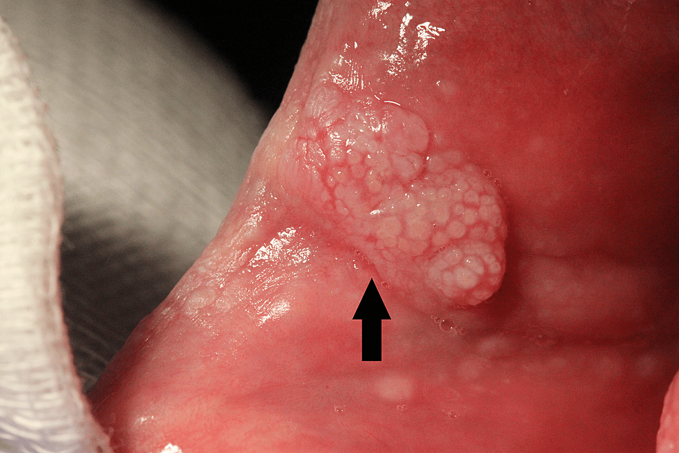 Lesion-B---White-papillomate-lesion-on-left-commissure-of-the-lips-(black-arrow)