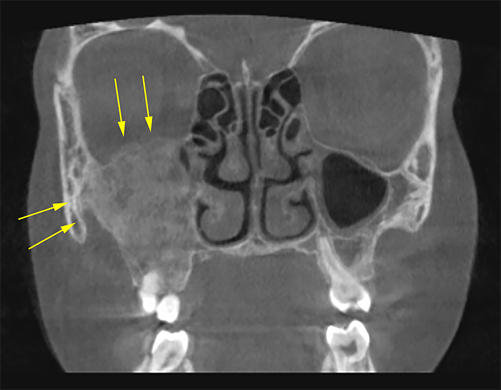 Maxillary Sinusitis Diagnosis And Management Sinusitis 