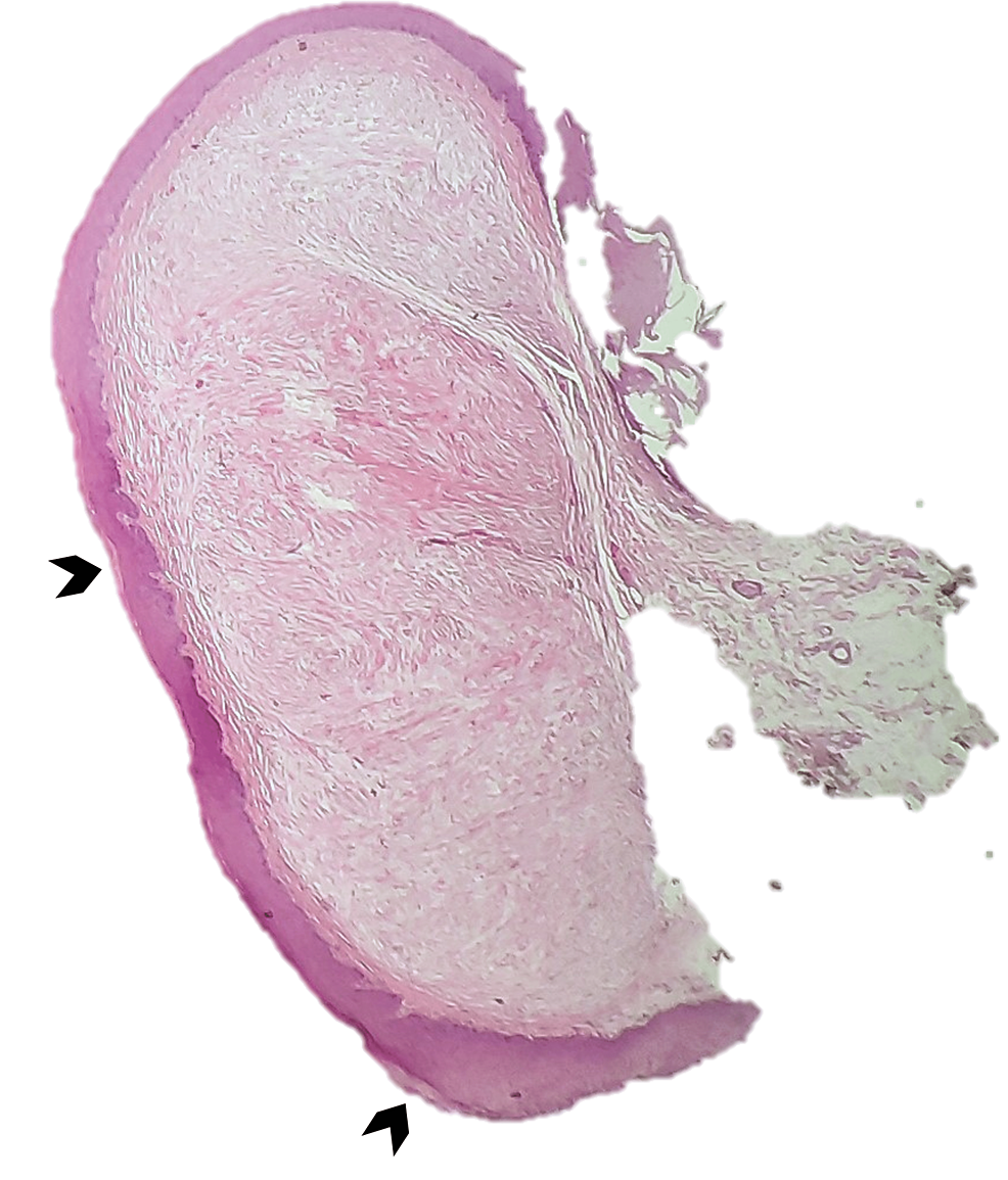 A-unencapsulated-hypocellular-nodule-located-in-the-lamina-propria,-covered-by-squamous-epithelial-with-keratinized-areas-(dark-fat-arrow)