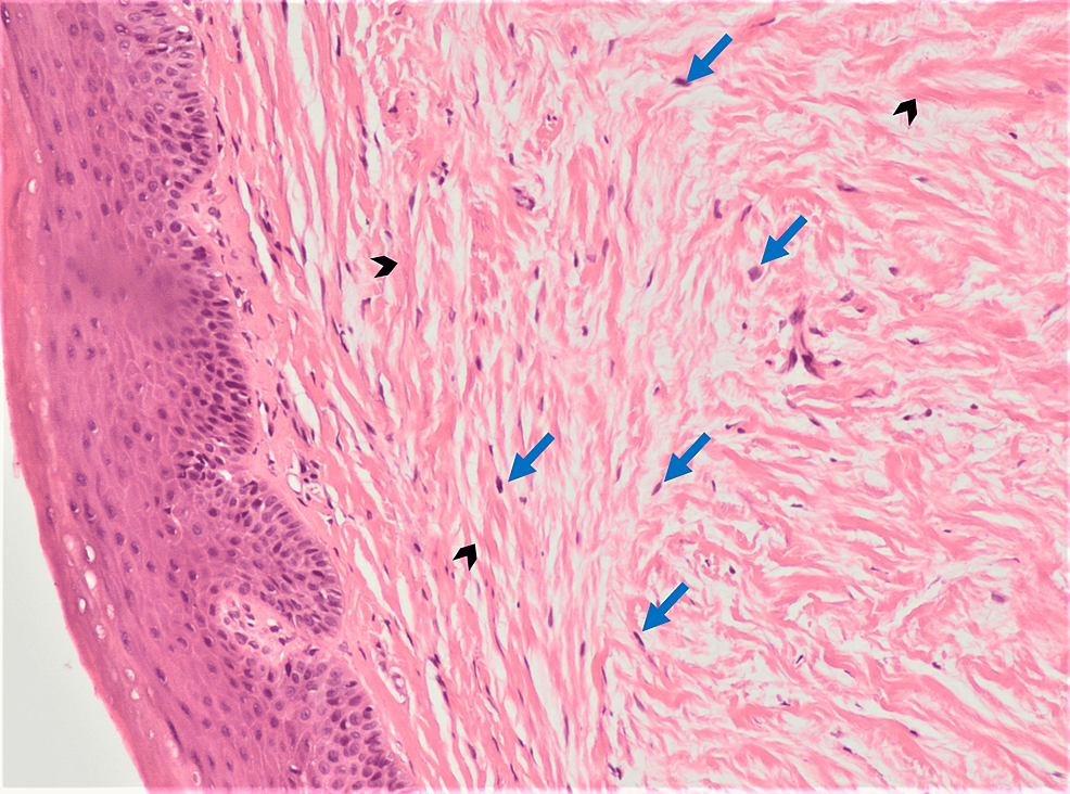 Eosinophilic-collagen-fibers-(dark-bold-arrow)-separated-by-prominent-slits-together-with-scattered-fibroblasts-(blue arrow)