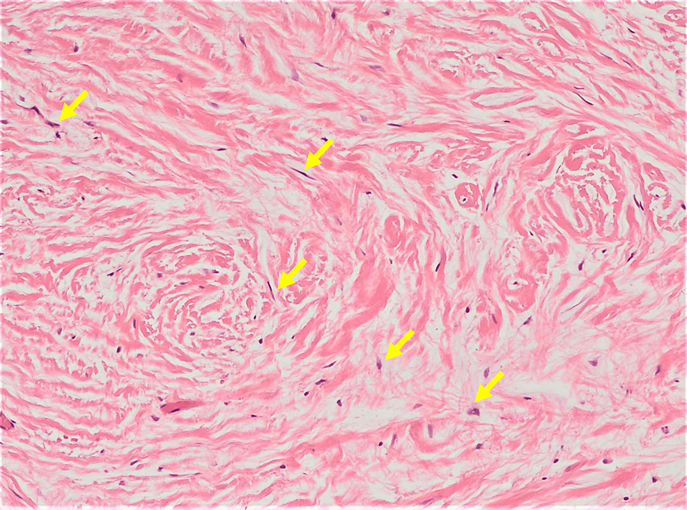 Scattered fibroblasts-(yellow arrow)-are-bland-and-mono-nuclear,-present-a-spindle-or-stellate-morphology