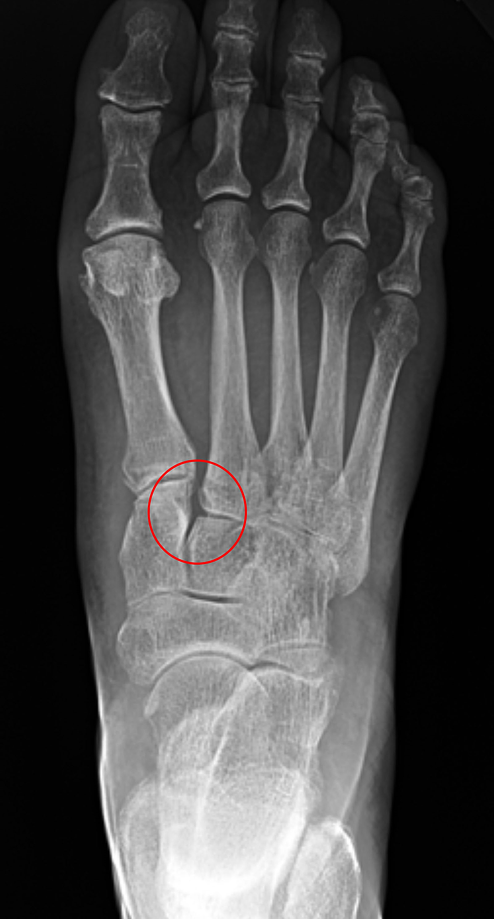 Lisfranc X Ray