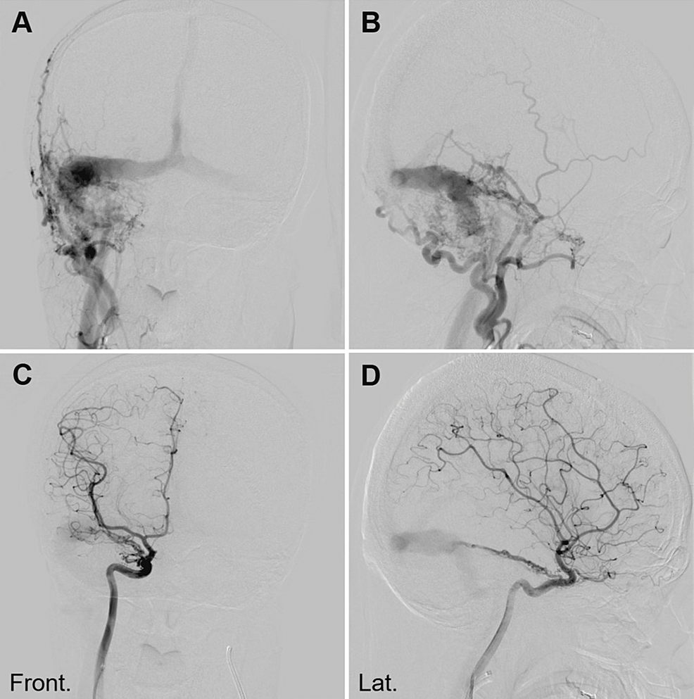 Digital-Subtraction-Angiogram-(DSA)-Showing-Right-Sided-Transverse-Sigmoid-Dural-Arteriovenous-Fistula-(TS-DAVF).
