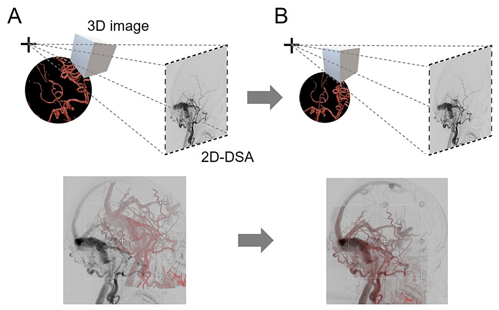 Schematic-Illustrations-of-the-Algorithm-for-the-Co-Registration-of-2D/3D-Vasculature-Images-by-Brainlab®-Elements.