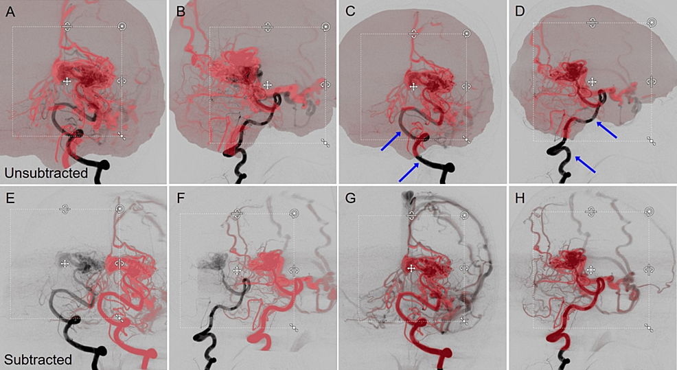 Comparison-of-Unsubtracted-and-Subtracted-CBCTA-Co-Registered-with-2D-DSA-for-Left-Occipital-Arteriovenous-Malformation.