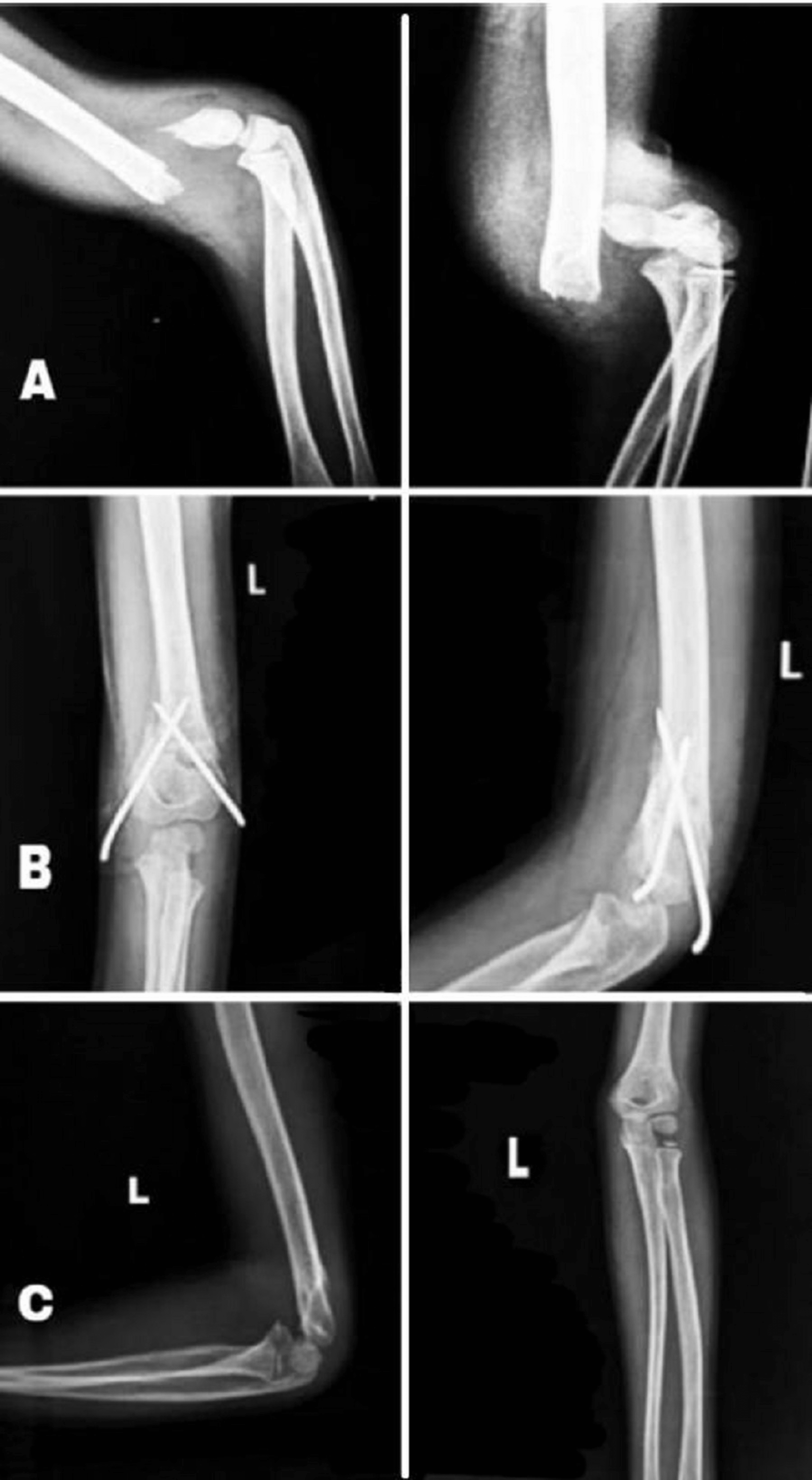 Cureus | Comparative Study of the Functional Outcome of Elbow Joint in ...