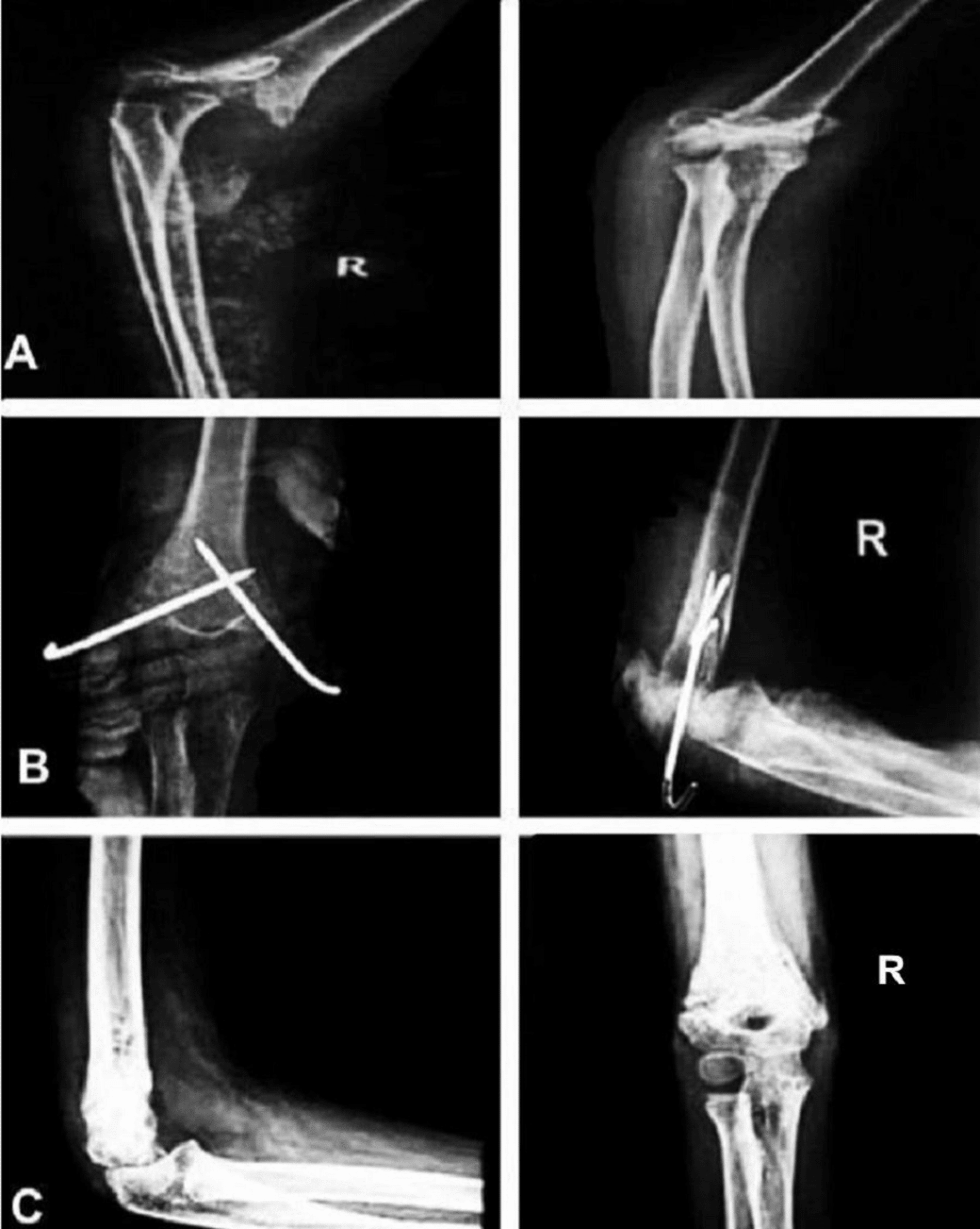 Cureus Comparative Study of the Functional of Elbow Joint in