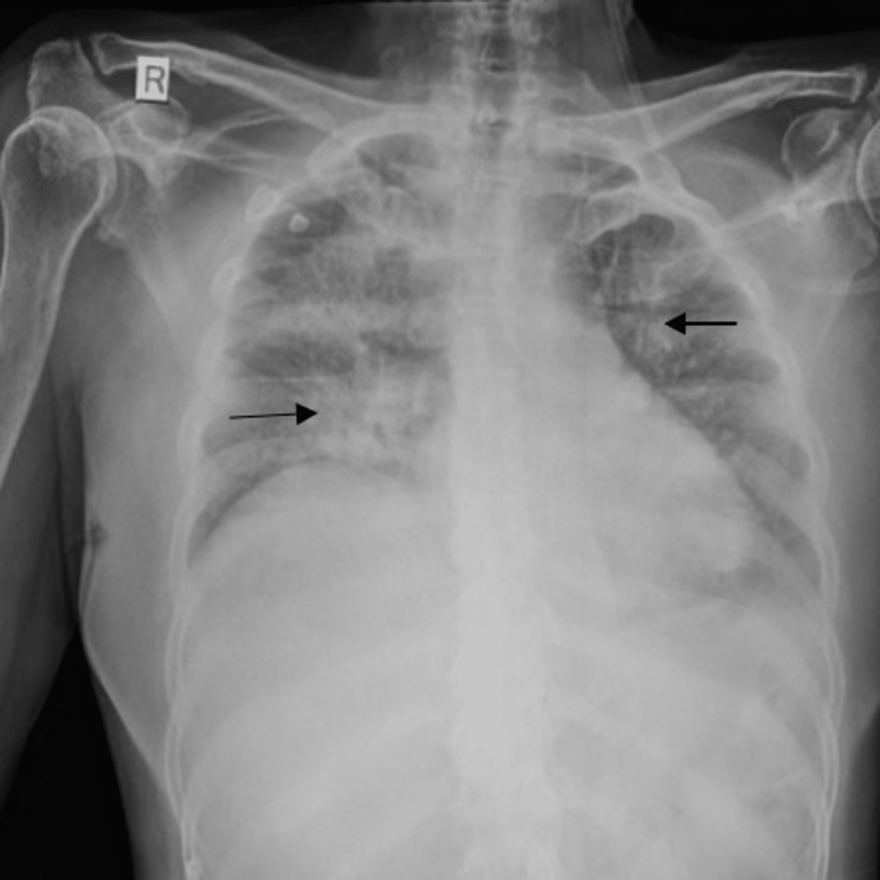 X-ray-of-the-chest-showing-diffuse-bronchopneumonia-in-right-and-left-lungs-(see-arrows)