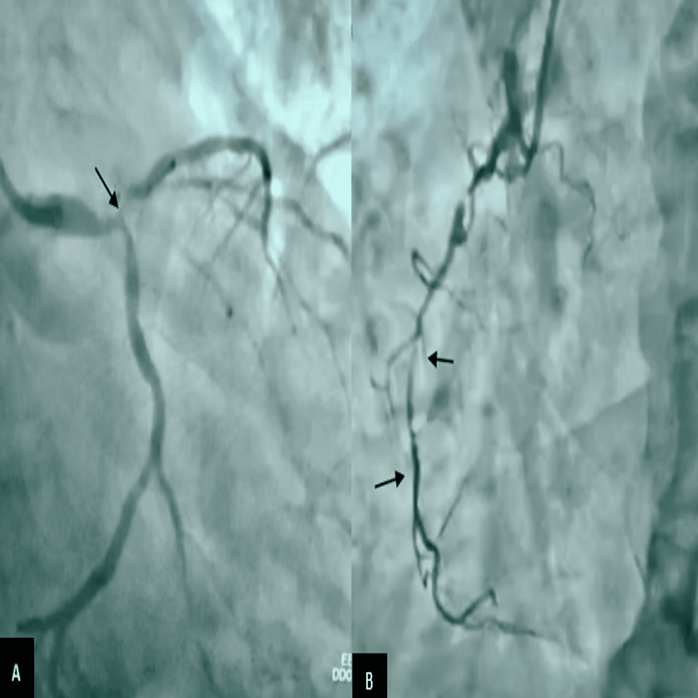 Pre-percutaneous-transluminal-coronary-angioplasty