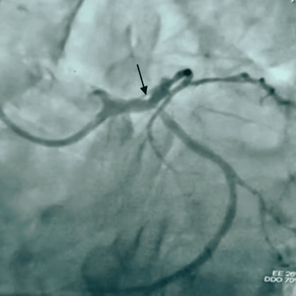 -The-left-main-artery-over-left-anterior-descending-artery-stenting-post-percutaneous-transluminal-coronary-angioplasty