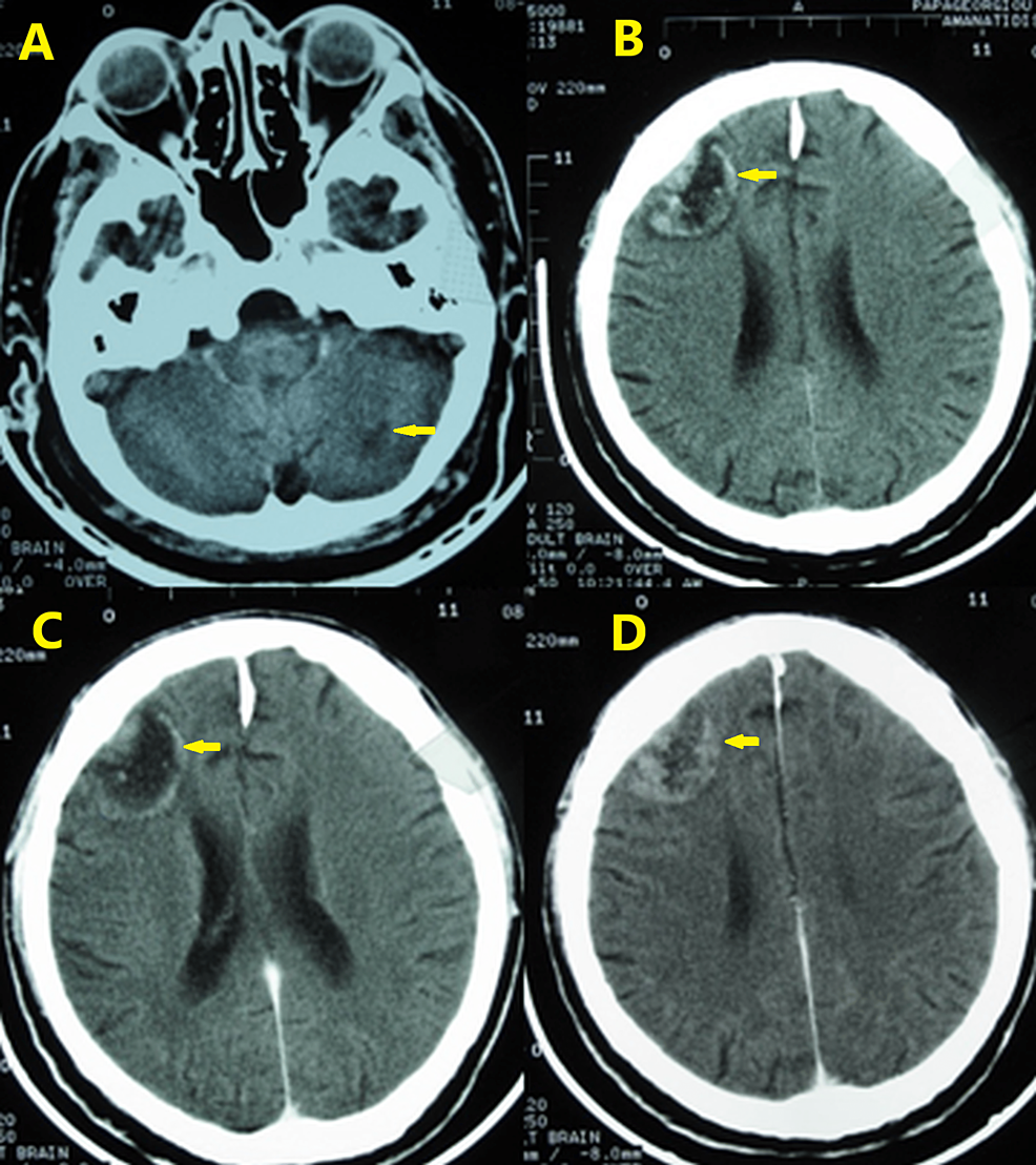 Brain-computed-tomography-scan-on-July-8,-2008.-Axial-CT-images-plus-contrast-medium.