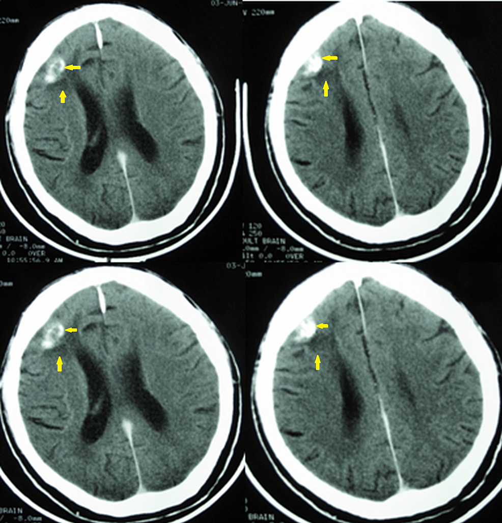 Brain-computed-tomography-scan-on-October-7,-2009.