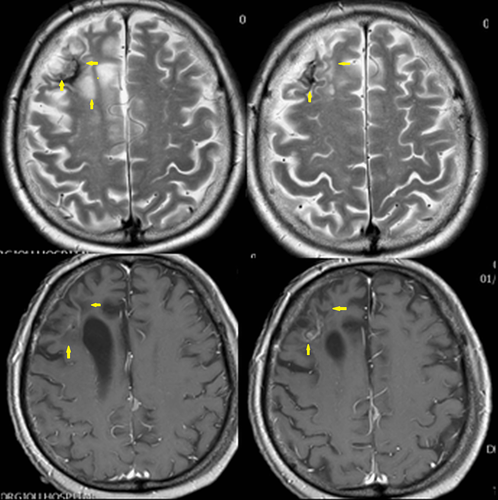 Brain-magnetic-resonance-imaging-on-January-10,-2018.