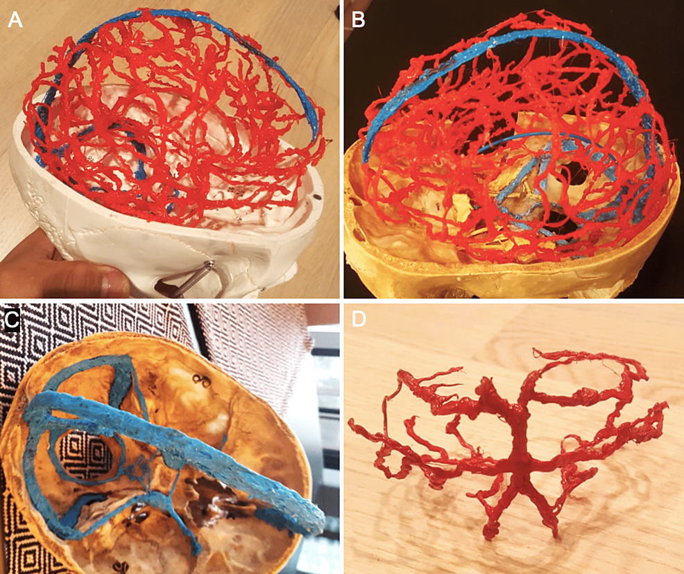 (A,-B)--The-arterial-(red)-and-venous-(blue)-vasculature-of-the-intracranial-cavity-has-been-printed-onto-a-skull-base-model-illustrating-the-three-dimensional-(3D)-relationships-between-vascular-and-bony-structures.-(C)-The-dural-venous-sinuses-have-been-3D-printed-onto-the-skull-base-in-blue.-(D)-3D-printed-objects-can-be-easily-detached-from-the-underlying-bone-frame-causing-no-damage-to-the-bone-or-the-3D-printed-structure.-The-posterior-arterial-circulation-was-initially-printed-on-a-cadaveric-skull-base-and-then-detached.---