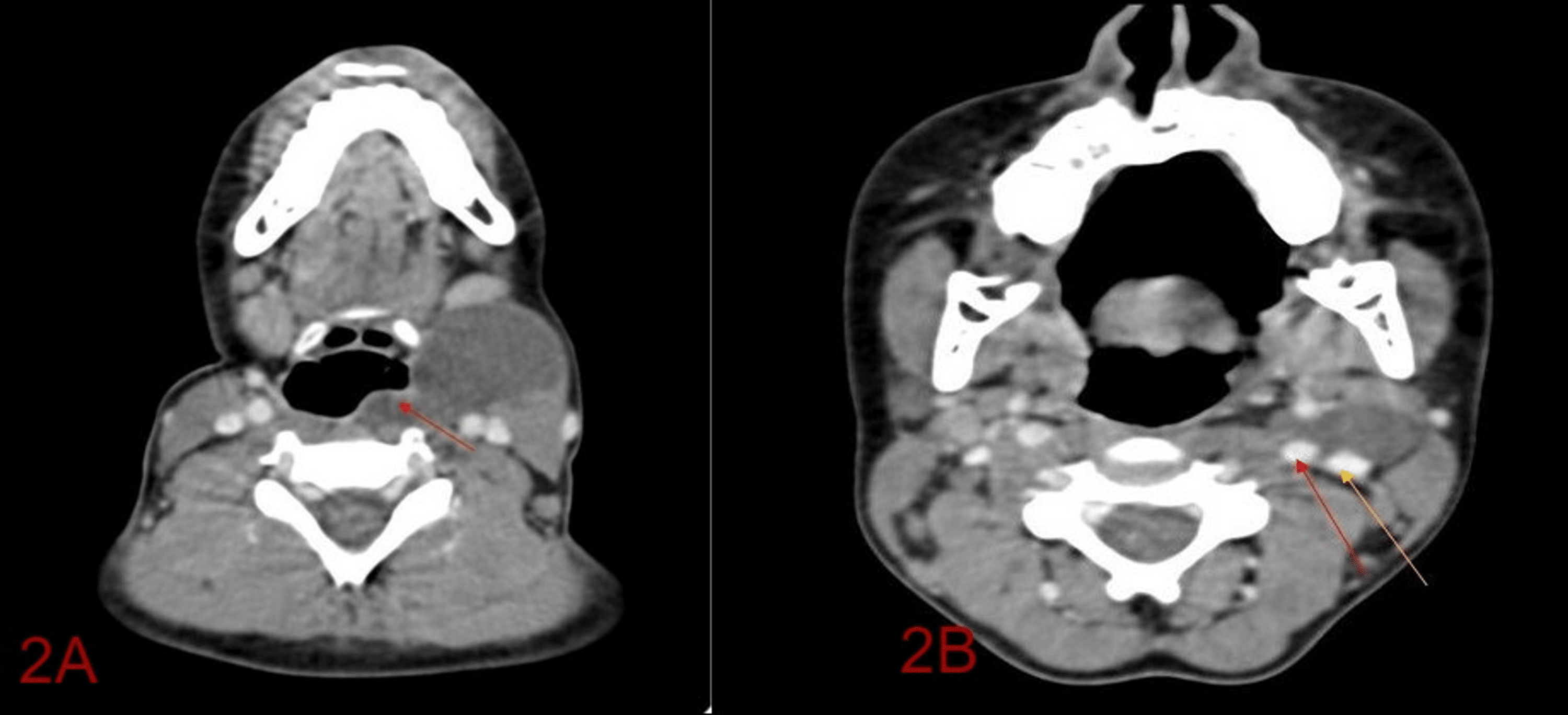 Cureus Type Iii Second Branchial Cleft Cyst A Rare Presentation