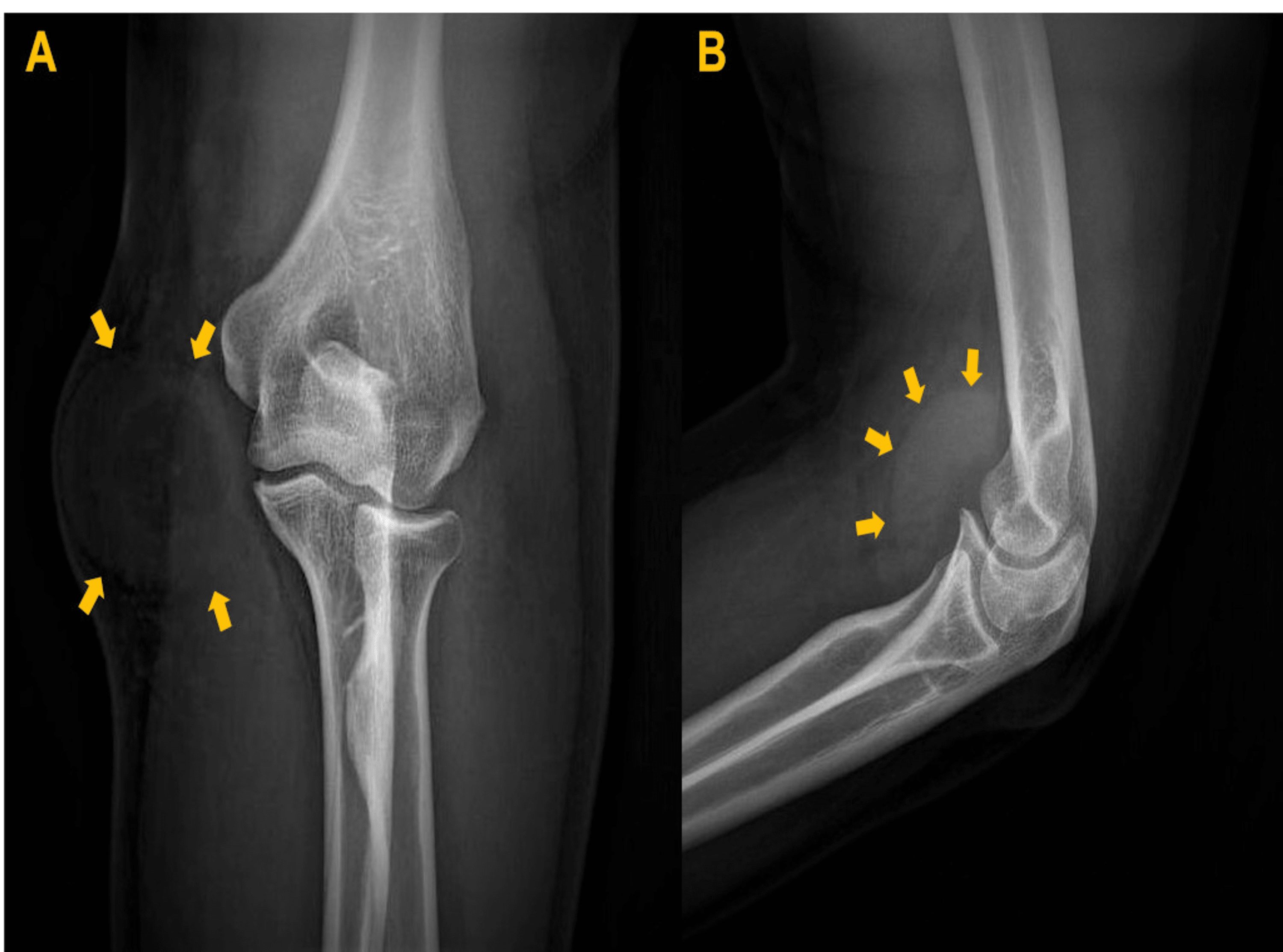 Cureus | Morel-Lavallée Lesion of the Elbow Region ‎in a Young Male ...