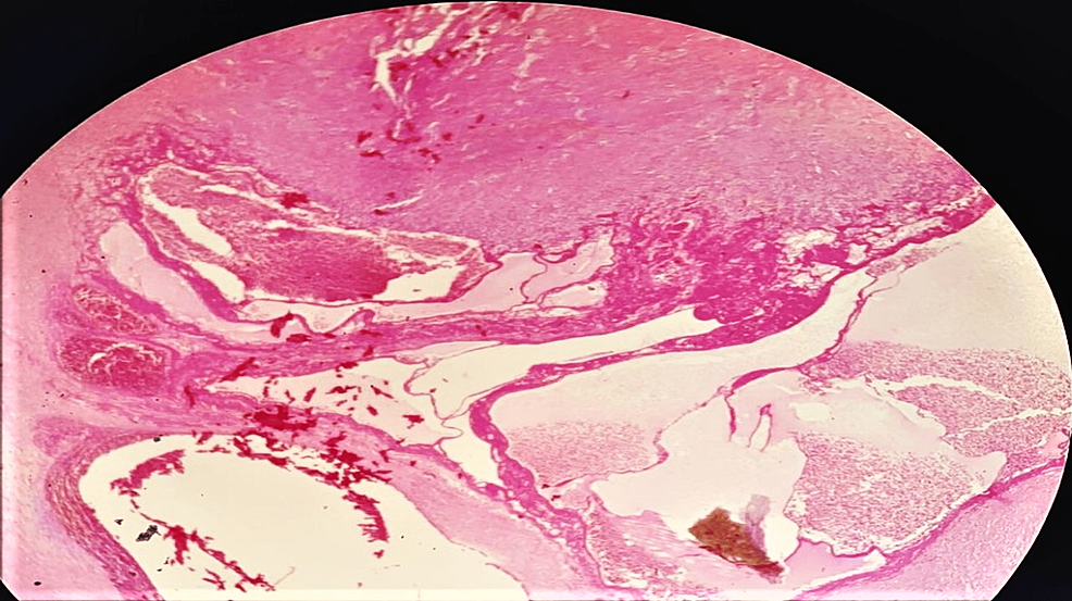 MorelLavallée Lesion of the Elbow Region ‎in a Young Male Case Report