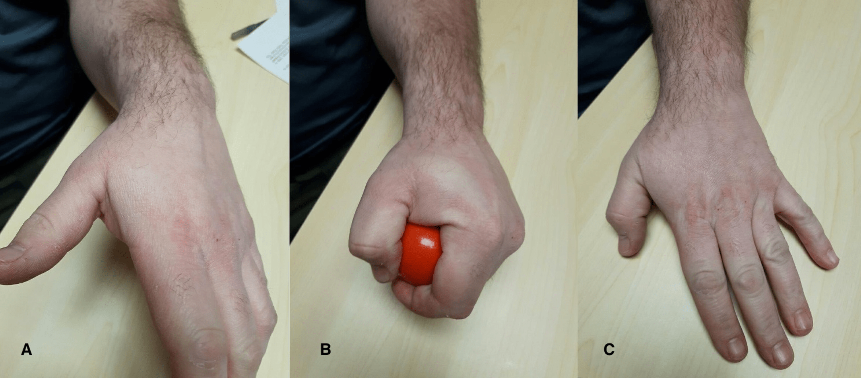 Cureus Chronic Exertional Compartment Syndrome of the Hand With