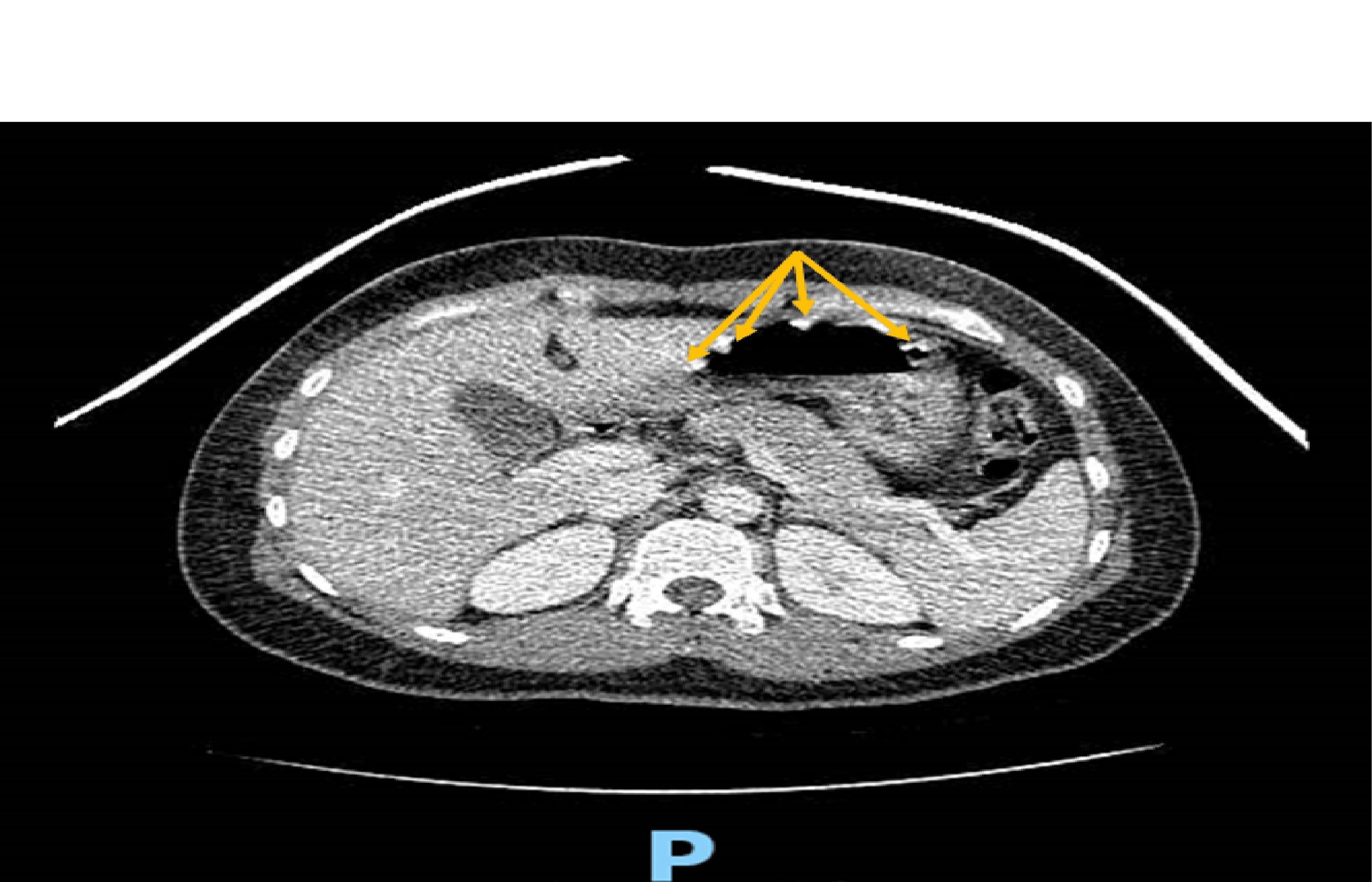 Cureus Ingested Potassium Chloride Pills on Imaging Misdiagnosed As