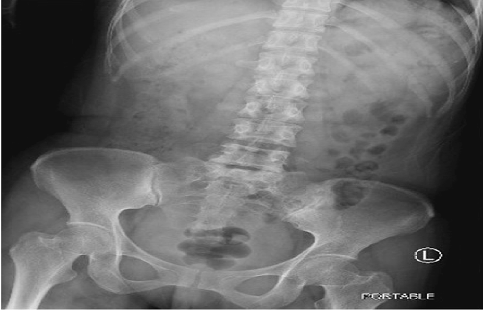 Cureus Ingested Potassium Chloride Pills on Imaging Misdiagnosed As
