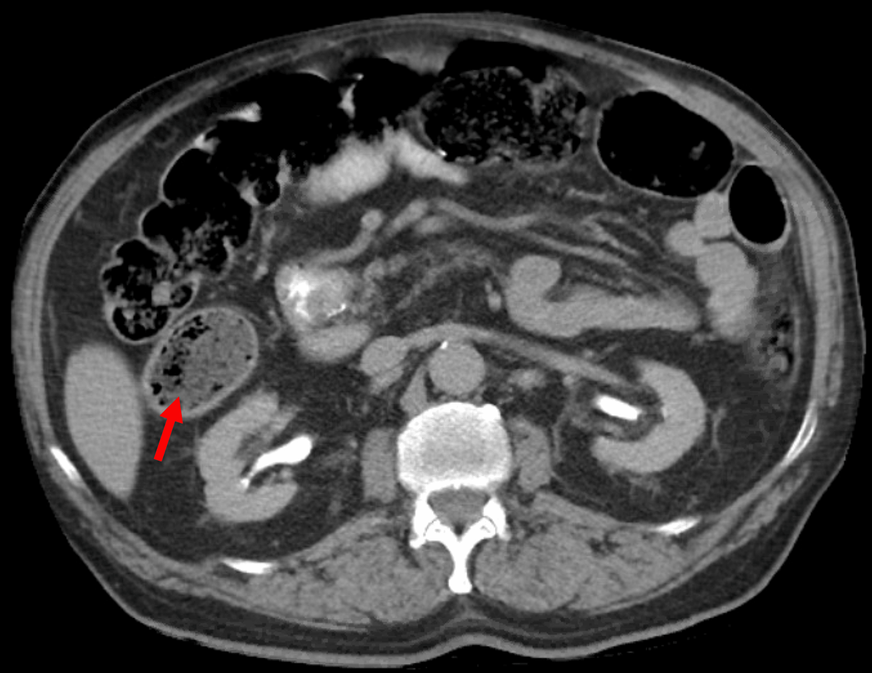 Cureus Cecal Diverticulitis in a Geriatric Patient