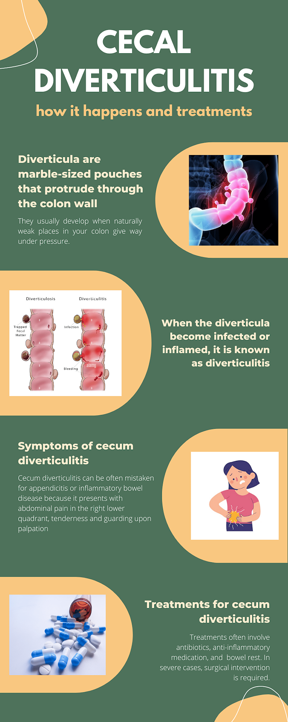 Cureus Cecal Diverticulitis in a Geriatric Patient