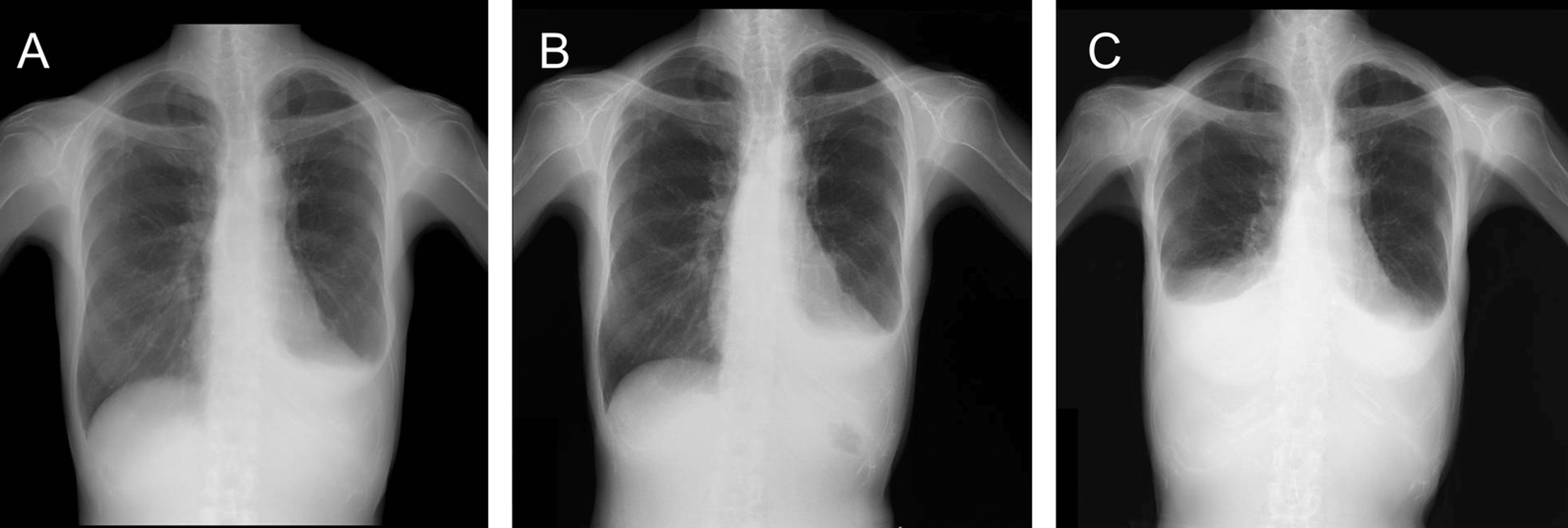 Cureus | Delayed Onset of Pleural Effusion After Thoracic Radiation ...