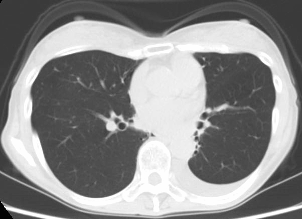 A-computed-tomography-scan-of-the-bronchi