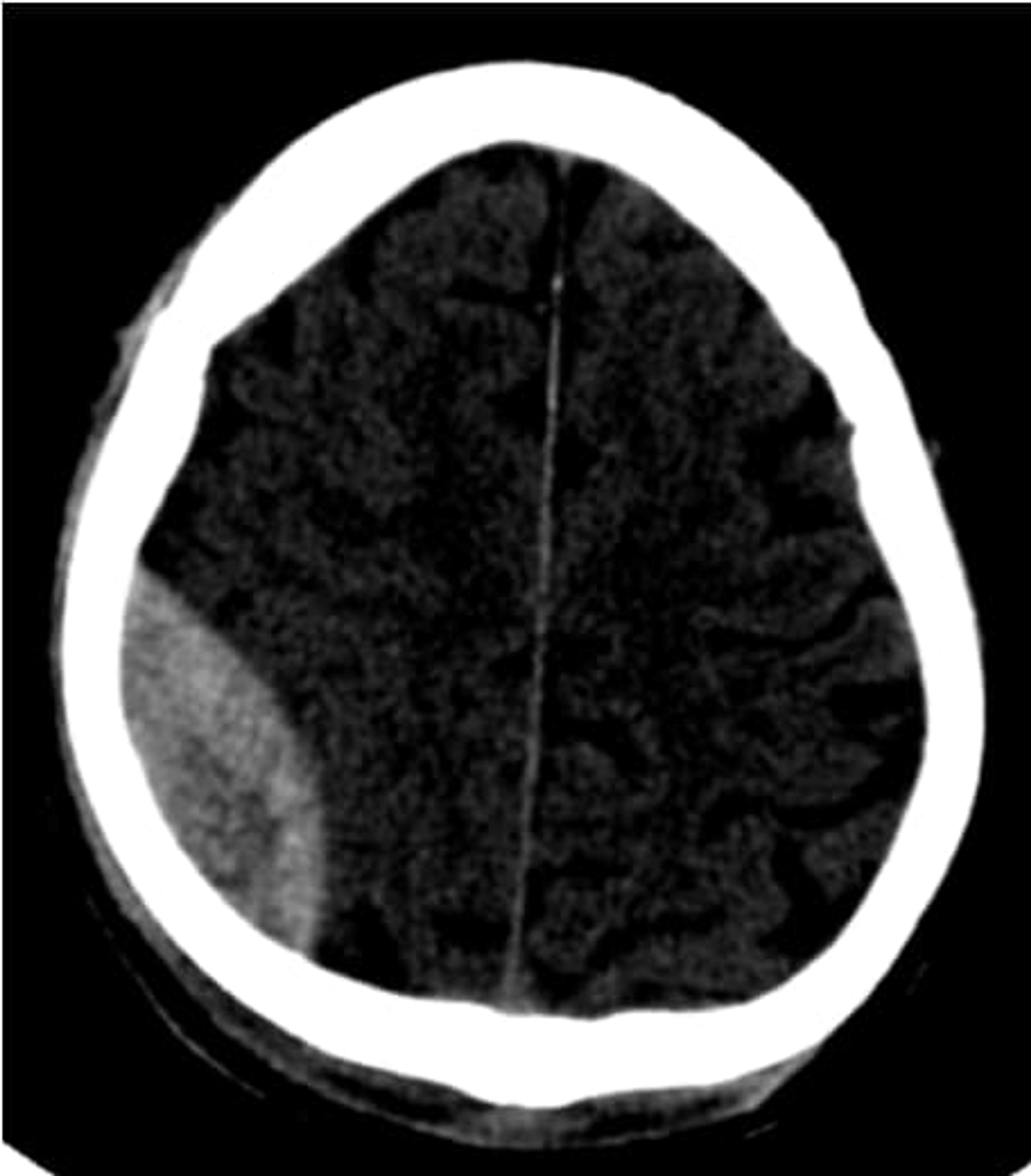 cureus-evaluation-of-sequential-head-computed-tomography-in-traumatic-brain-injuries