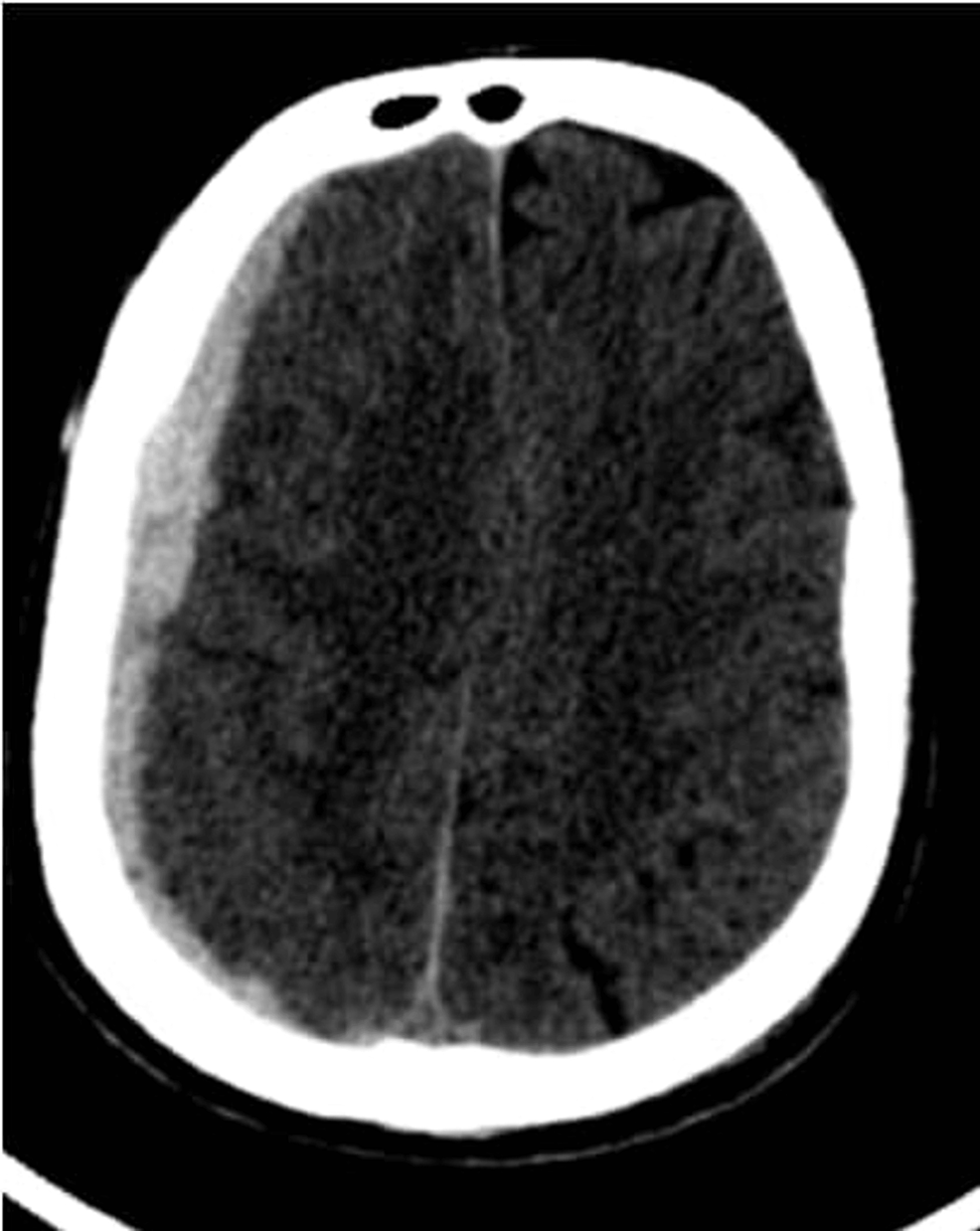 Cureus | Evaluation of Sequential Head Computed Tomography in Traumatic ...