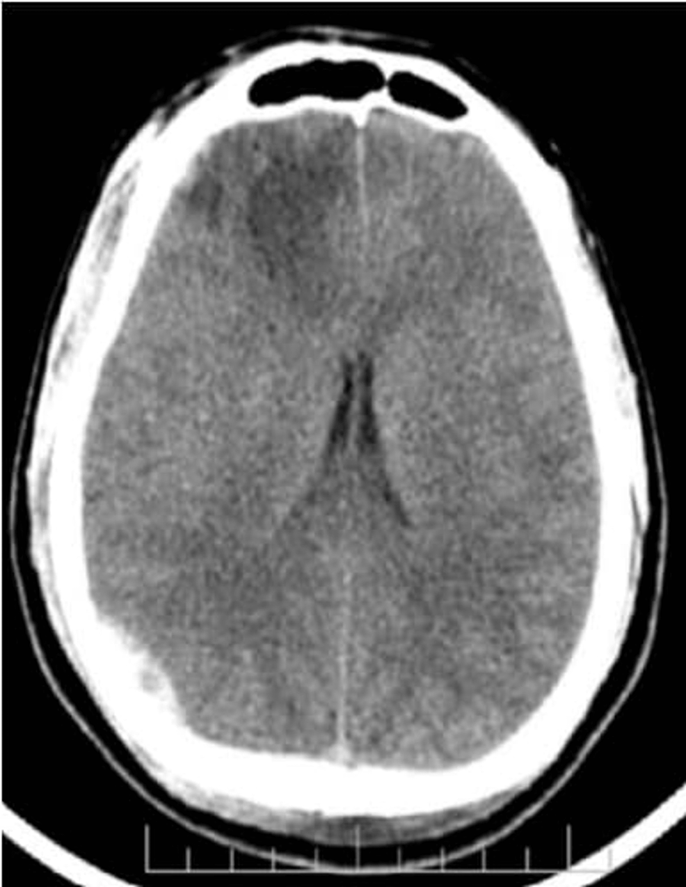 Cureus | Evaluation of Sequential Head Computed Tomography in Traumatic ...